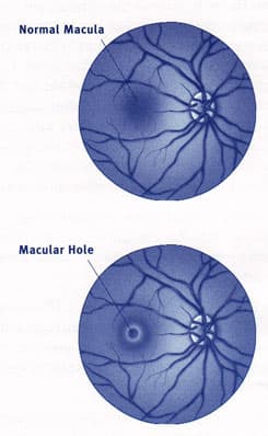 Can macular holes cause migraines??