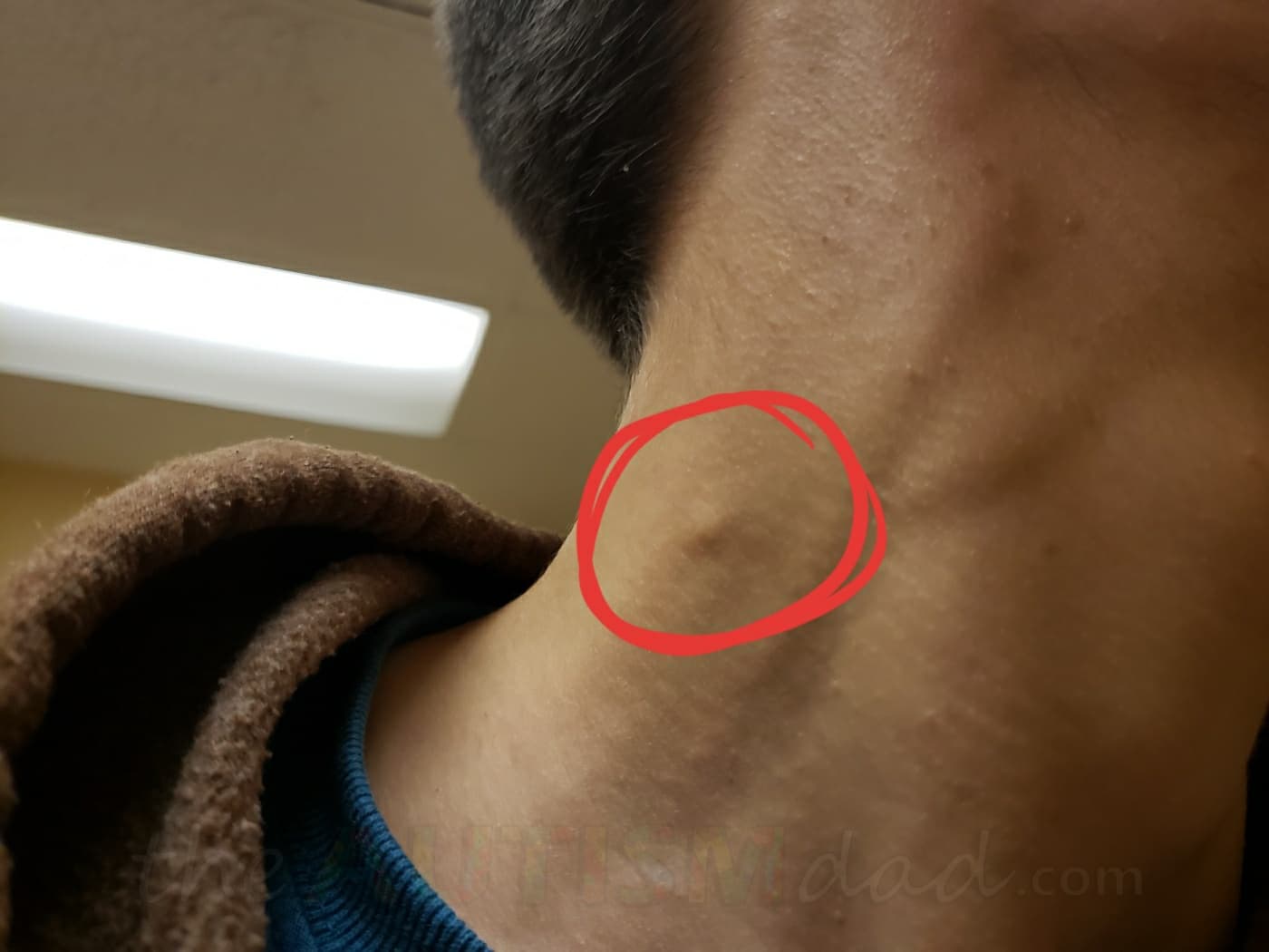 Here's what we learned about the mass in Gavin's forearm and what we're doing next