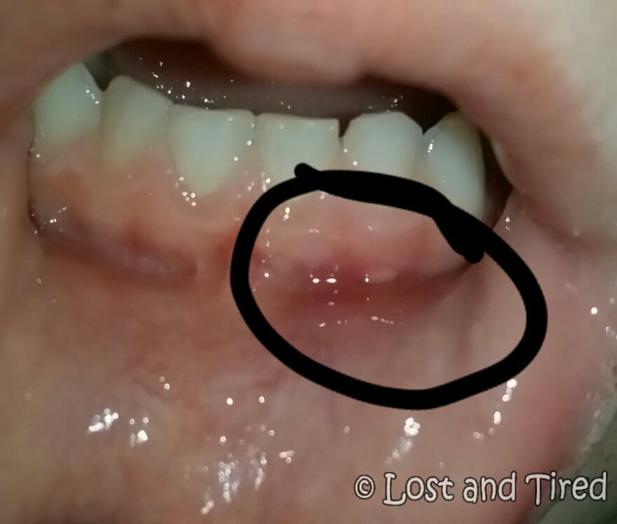 PAINFUL SORES - Poor Emmett is in pain again
