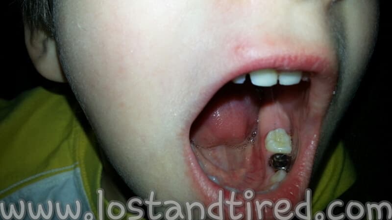 The super tooth